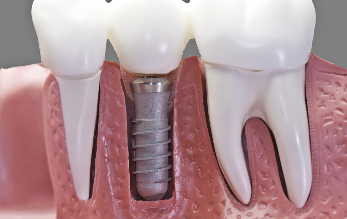 Dental Implants in Florida Made Simple