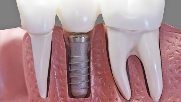 Dental Implants in Florida Made Simple