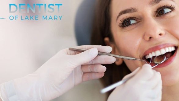 What You Should Know About Teeth Whitening in Lake Mary