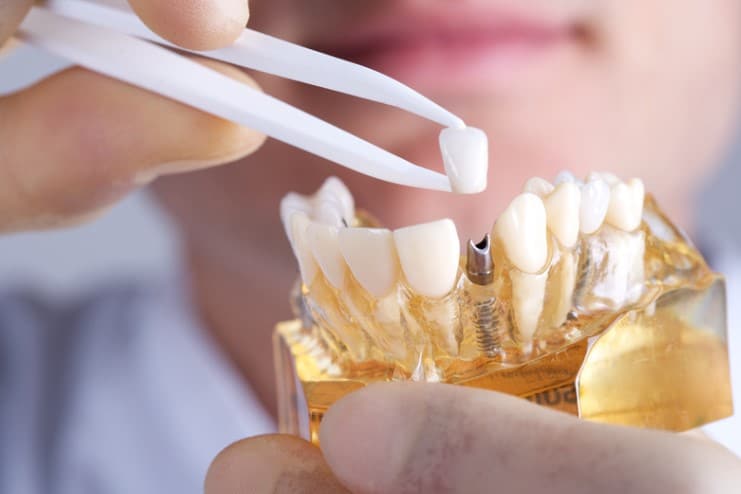 The Variety of Benefits with Dental Implants
